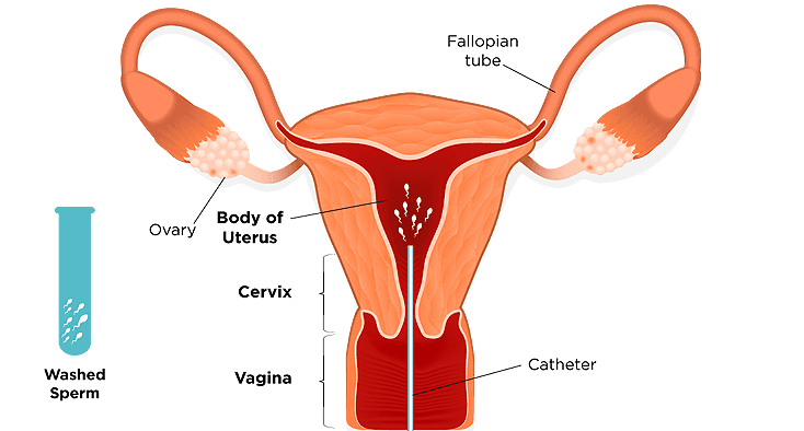 IUI Treatment